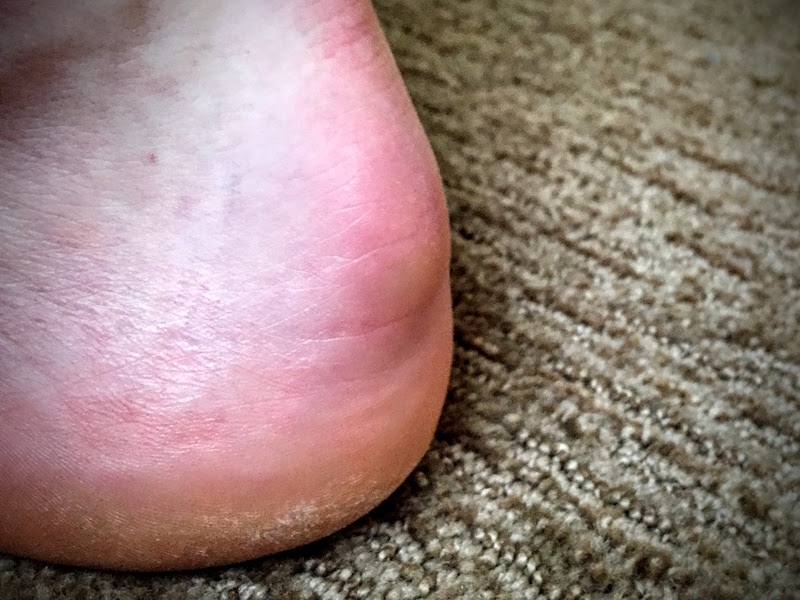 Day -1: The original bone spur. It doesn&rsquo;t look to inflamed in this picture since I had been icing it and out of ski boots and climbing shoes for 4 months at this point.