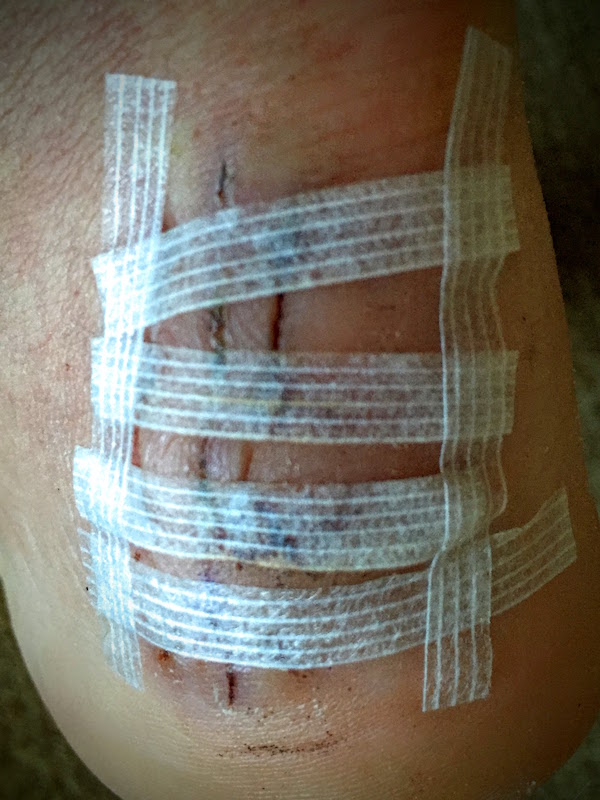 Day 14: Stitches out, rehab on!