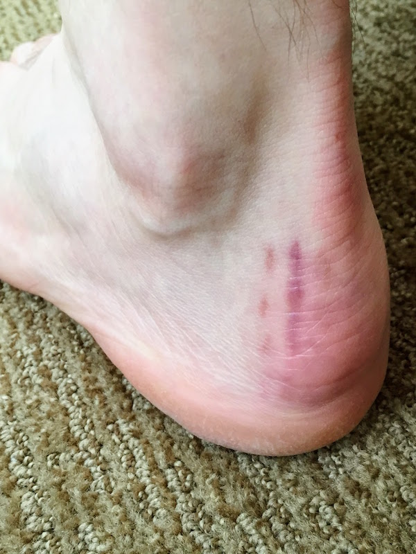 Day 153: The incision is pretty smooth at this point and the scar tissue is starting to decrease. It&rsquo;s still a bit more sensitive than my other heel, but it&rsquo;s not painful and I can wear any shoes I want at this point.