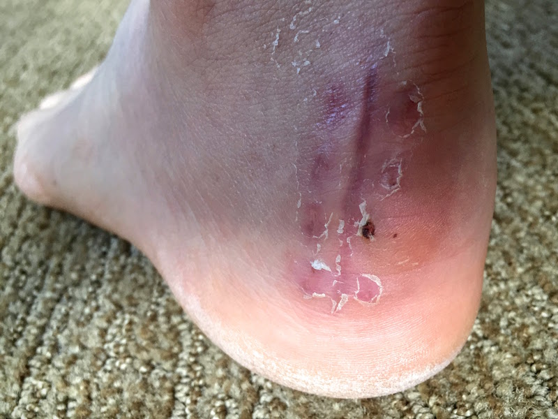 What is the Recovery Time for Heel Spur Surgery?